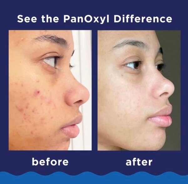 screenshot-45 غسول PanOxyl الفوّاح لعلاج حب الشباب – قوة 10% بنزويل بروكسايد
